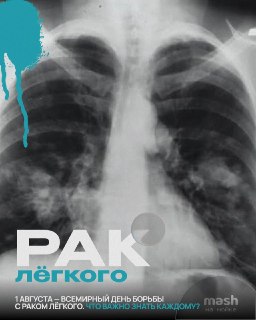 Сложности ранней диагностики рака лёгкого: важные факты и советы